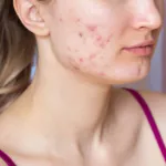 Celiakia: autoimunitné ochorenie, ktoré ovplyvňuje celý organizmus