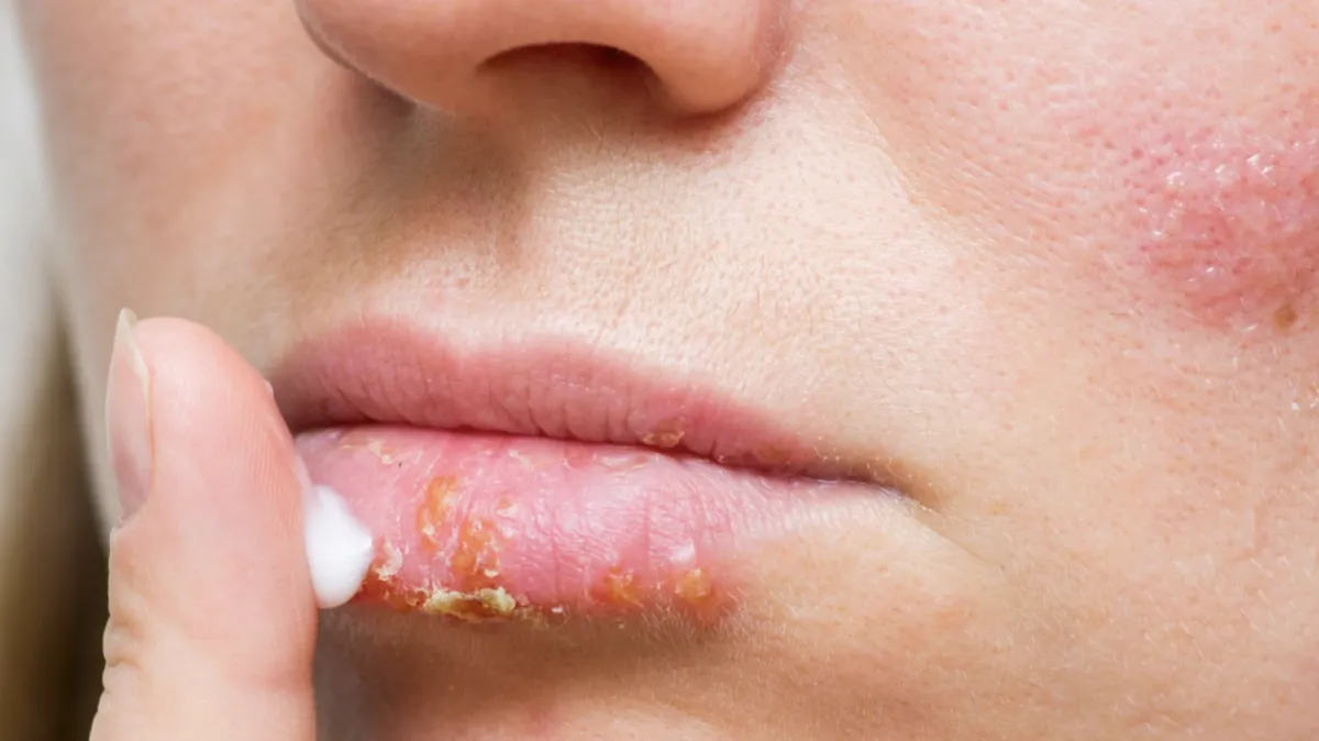 herpes-simplex-1.28.51 herpes-simplex-1.28.51